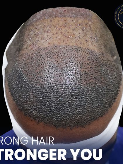 This is where science meets style. A detailed view of newly implanted hair follicles, showcasing the meticulous process of high-density hair restoration.