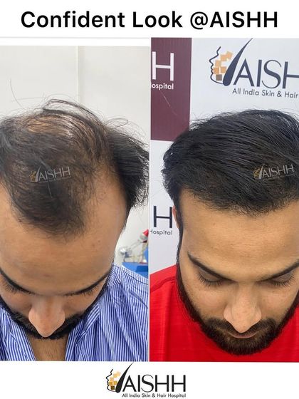 A top-down view showcasing the excellent coverage achieved. We addressed the thinning on the crown and mid-scalp, resulting in a full appearance from all angles.