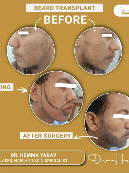 A beard transplant is a journey to renewed confidence. This image shows the key stages of the process, from the initial consultation and precise markings for the new hairline, to the final, dense beard growth after the procedure. I design the shape to perfectly suit your facial structure.