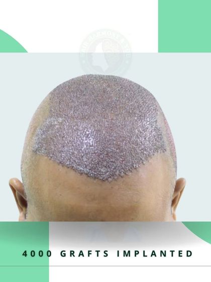 This image shows the scalp immediately after 4000 grafts have been implanted. You can see the density and coverage achieved, which will grow into a full head of hair.
