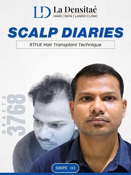 This is Mr. Suryakant’s story of taking control. Using the RT-FUE technique with 3,768 grafts, I helped him get back the look he'd been missing. His journey is about choosing confidence and peace of mind.