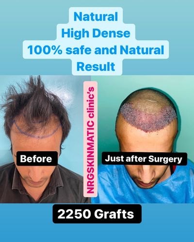 Hair Transplant Surgery