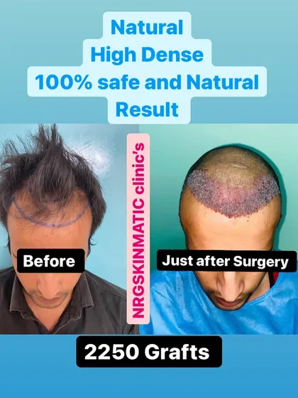Here is a client before and just after surgery, where 2250 grafts were implanted to create a new, dense hairline. This demonstrates what you can expect on the day of your high-density FUE transplant.