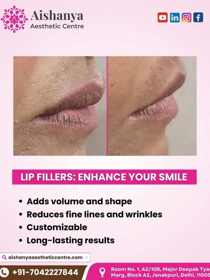 This graphic clearly outlines the benefits of lip fillers. Beyond just adding volume, they can reduce fine lines around the mouth and are fully customizable to enhance your unique smile.