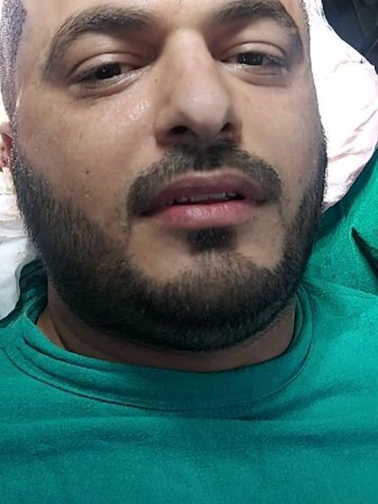 A patient resting comfortably during the hair transplant procedure. We prioritize patient comfort throughout the entire process.