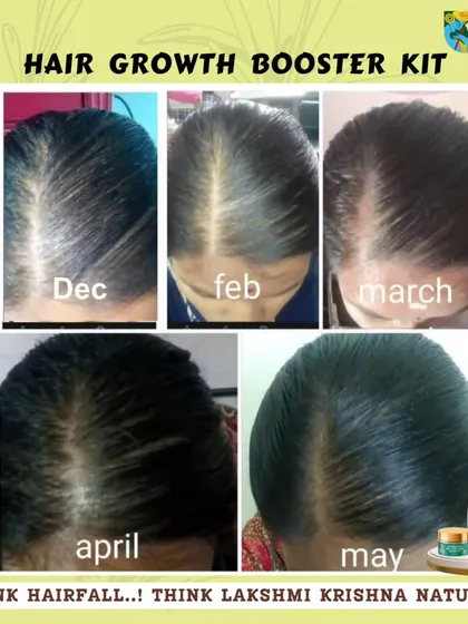 This is what consistent, natural care can do. This before-and-after collage shows the real progress from using my Hair Growth Booster Kit over five months, resulting in visibly denser and healthier hair.
