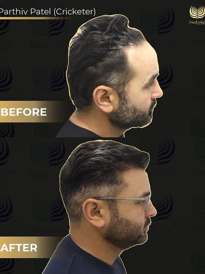 A side-profile before and after of cricketer Parthiv Patel. We implanted 2400 grafts to address his Grade 2 baldness, focusing on the hairline and frontal density for a fuller, youthful look.