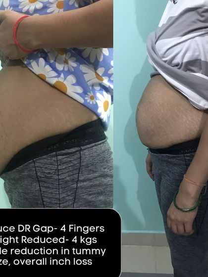With a 4-finger DR gap, this client lost 4kg and saw a visible reduction in tummy size and overall inch loss.