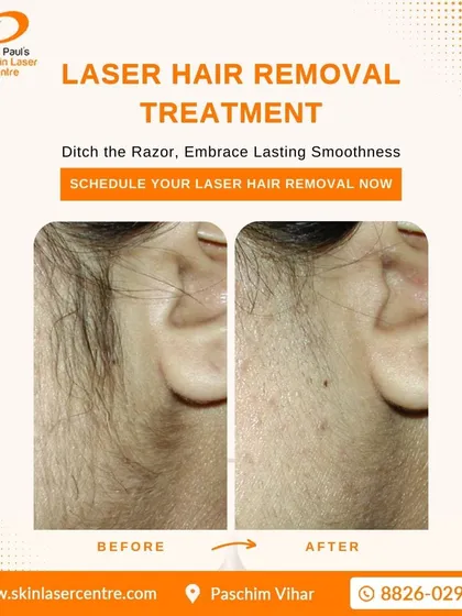 This is a typical result from my laser hair reduction treatment. It provides a long term solution for unwanted hair, leaving the skin smooth and clear compared to temporary methods like shaving.