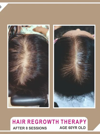 It's never too late to invest in your hair. This wonderful 60-year-old client saw a remarkable improvement in her hair volume and scalp coverage after completing 8 sessions of our hair regrowth therapy.