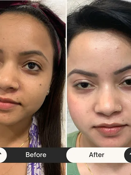 Witness the power of my Miracle Facial in just one session. This before and after shows a dramatic improvement in skin clarity, texture, and overall radiance. My goal is to give you skin that feels so good, you need less makeup to feel confident.