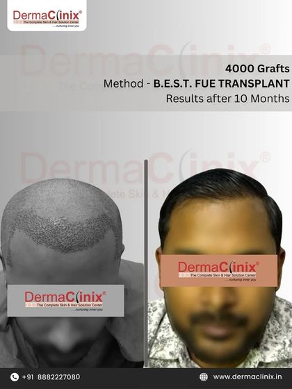 A 10 month result from a 4000 graft B.E.S.T. FUE transplant. This case shows a significant restoration of hair in the crown and mid scalp area, resulting in a much fuller look.