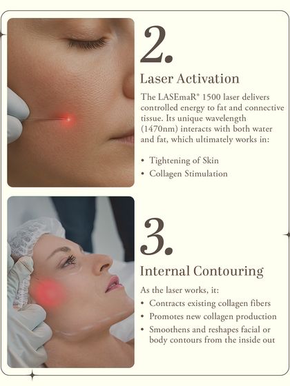 Next, the laser is activated. The LASEmaR 1500 laser delivers controlled energy to the fat and connective tissue. Its unique wavelength interacts with both water and fat, triggering skin tightening and collagen stimulation for internal contouring.