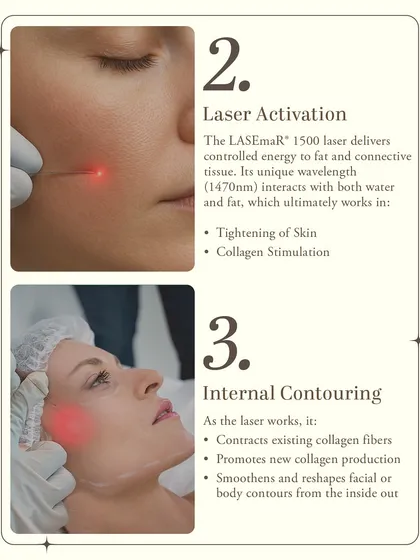 Next, the laser is activated. The LASEmaR 1500 laser delivers controlled energy to the fat and connective tissue. Its unique wavelength interacts with both water and fat, triggering skin tightening and collagen stimulation for internal contouring.