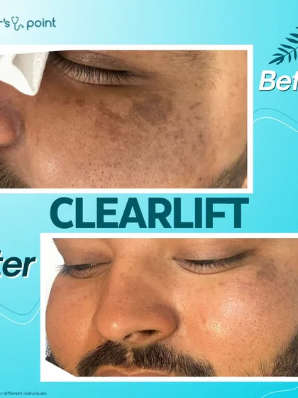 A clear before and after comparison of our ClearLift treatment. You can see a significant reduction in pigmentation and a more even, radiant skin tone.