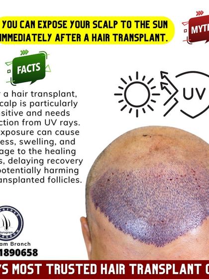 **Myth:** You can expose your scalp to the sun immediately after a hair transplant. **Fact:** Your scalp is very sensitive after the procedure. Sun exposure can cause redness and damage healing tissue, so it must be protected.