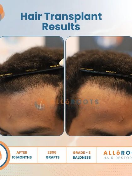 This 10-month result for a Grade 3 baldness case, using 2806 grafts, showcases a significant improvement in density and a perfectly restored hairline from all angles.
