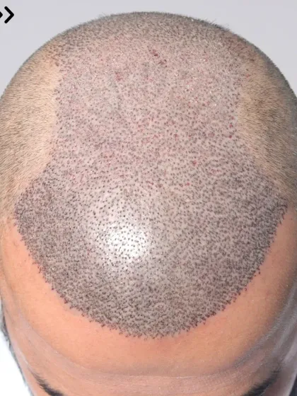 A close-up of graft placement for a Norwood Grade 6 case. 6000 grafts were implanted in a single session for full coverage.