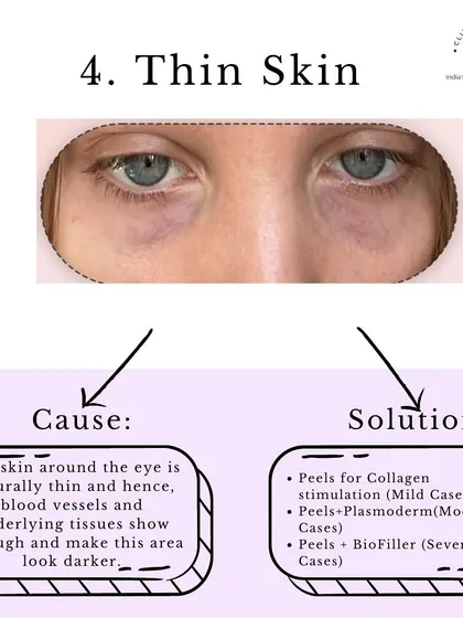 Problem: Thin Skin. The skin around the eye is naturally thin, allowing blood vessels to show through. We can address this with collagen-stimulating peels, PlasmoDerm, or BioFiller to thicken and strengthen the skin.