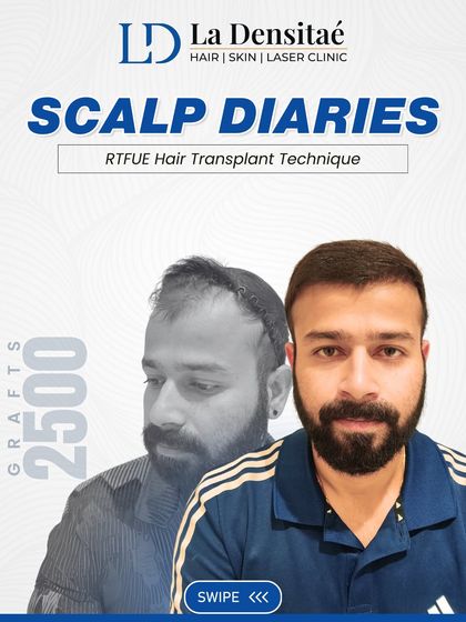 Vikas had been losing his hair and confidence for years. With the RT-FUE technique and 2,500 grafts, I rebuilt his hairline naturally, with no scars. His journey is proof that the right step at the right time can change everything.