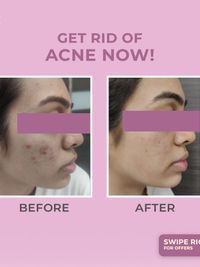 Acne, Scar & Pigmentation Treatments