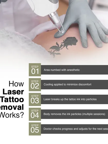 Wondering how tattoo removal works? This is my five-step process. I start by numbing the area, use a cooling technique to minimize discomfort, and then use the laser to break down the ink. Your body does the rest, and I adjust the treatment at each session for the best results.