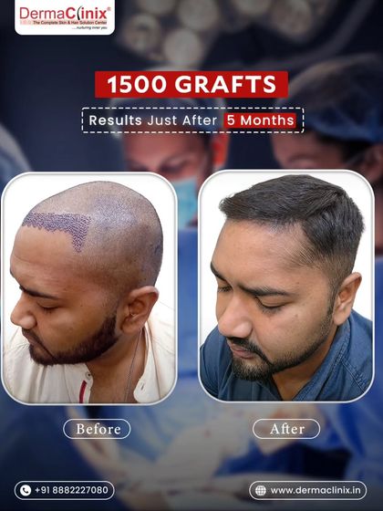 Another angle of the 1500 graft hair transplant after five months, highlighting the restored hairline from the side profile. The hair is styled to show the natural flow and density.