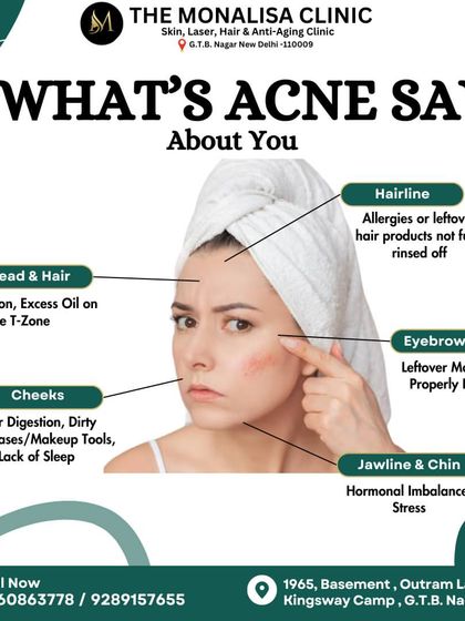 The location of your acne can tell you a lot about its cause. This face map links breakouts on the forehead, cheeks, and jawline to potential triggers like hormones, diet, or leftover makeup.