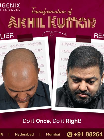 See the powerful transformation of former international boxer Akhil Kumar, who notes the procedure gave him a softer, more approachable look.