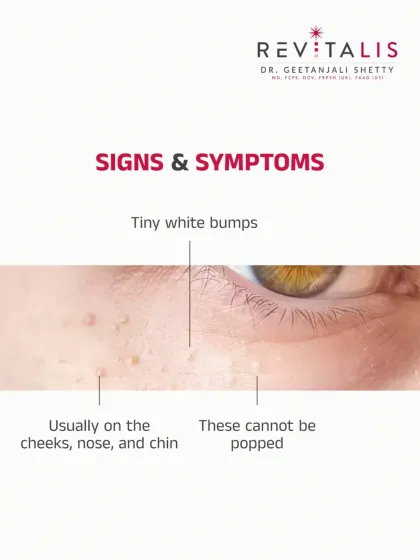 Signs and Symptoms of Milia. A close-up visual guide to recognizing milia. They appear as tiny, hard, white bumps on the cheeks, nose, and chin and feel different from a typical pimple.