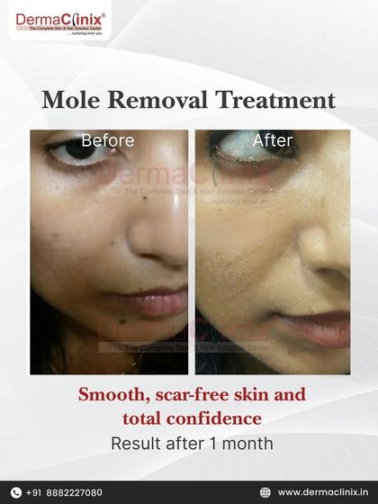 Another example of our successful mole removal treatment, showing a clear result just one month after the procedure. We focus on achieving smooth, scar-free skin to restore total confidence.