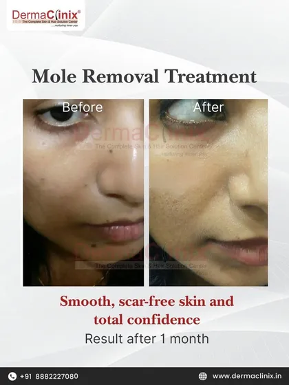 Another example of our successful mole removal treatment, showing a clear result just one month after the procedure. We focus on achieving smooth, scar-free skin to restore total confidence.