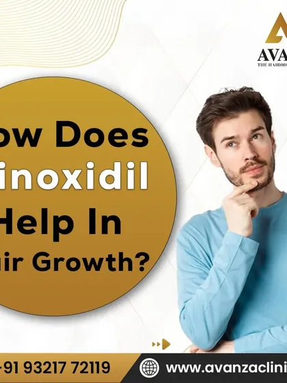 For many clients, non-surgical options are the best starting point. This graphic explains how a medically-proven solution like Minoxidil works to stimulate hair growth. We believe in educating you about all effective treatment paths available.