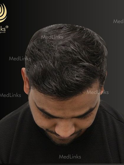 The top-down view after the transplant, showcasing the full coverage achieved.