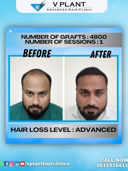 A powerful before-and-after result for a client with advanced hair loss, achieved with 4800 grafts in a single session. This demonstrates our capability to handle extensive cases and deliver transformative outcomes.