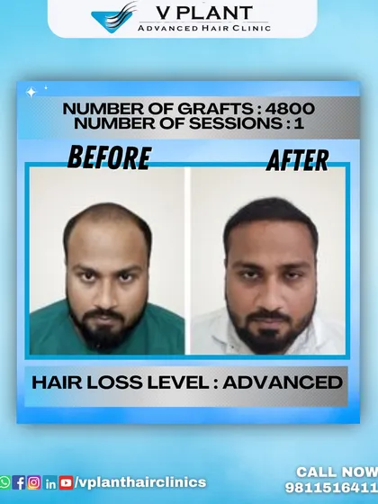 A powerful before-and-after result for a client with advanced hair loss, achieved with 4800 grafts in a single session. This demonstrates our capability to handle extensive cases and deliver transformative outcomes.