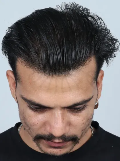 This 33-month result for a Grade 6 patient shows the long-lasting and natural outcome of his 4700-graft procedure.