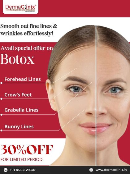 This graphic shows the areas where Botox is effective for smoothing dynamic wrinkles, such as forehead lines, crow's feet, and glabellar lines. We offer this treatment with a special discount for a limited period.