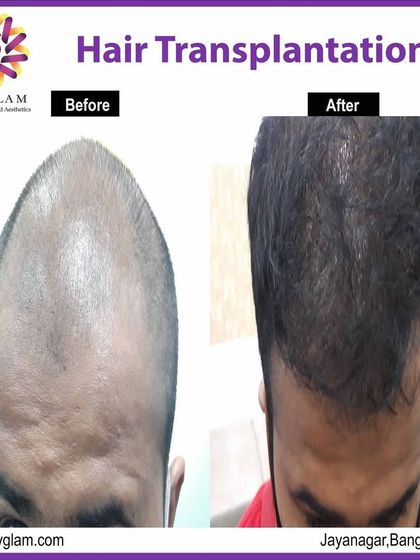 From advanced baldness to a full head of hair. This client's transformation highlights the power of our hair transplant procedure to restore a complete and natural hairline.