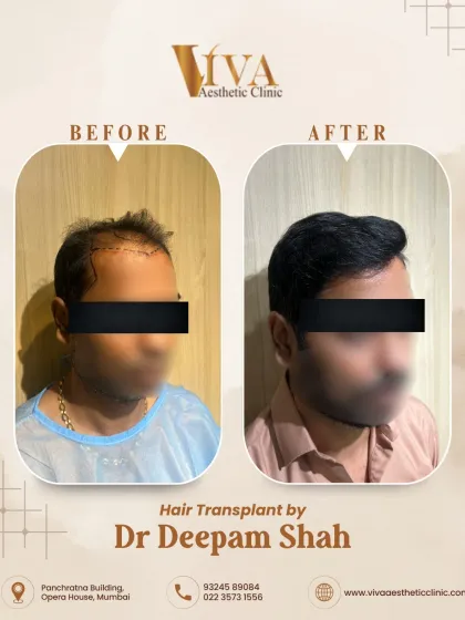 This patient had Grade 4 hair loss, which involves significant thinning in the front and mid-scalp. This image shows the before and after from the side, demonstrating how 3700 grafts restored his profile.