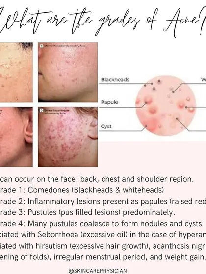 Acne isn't one-size-fits-all. I diagnose it in grades, from Grade 1 (blackheads and whiteheads) to Grade 4 (severe cysts and nodules), which helps determine the most effective treatment path.