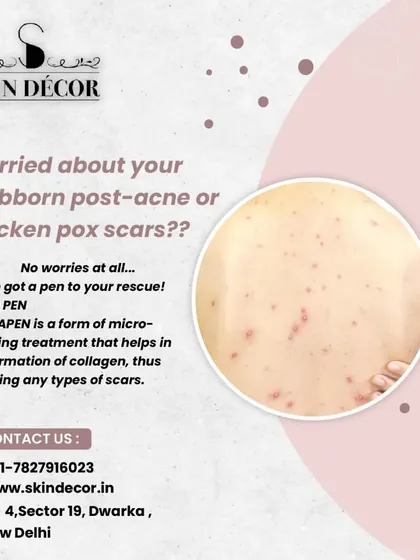 For stubborn post-acne marks or even chicken pox scars, the Dermapen is a fantastic solution. This microneedling device creates controlled micro-injuries in the skin, which stimulates the natural production of collagen and helps significantly reduce the appearance of various types of scars over time.