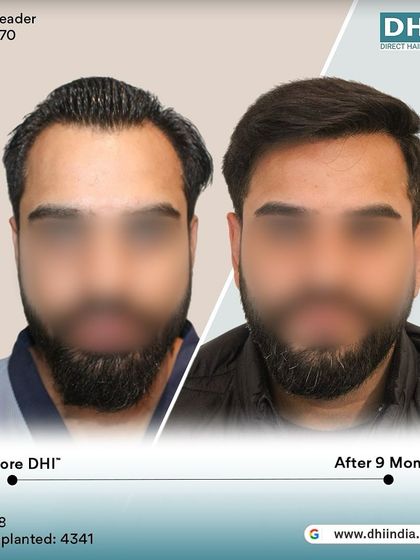 A before and after of a 28-year-old client 9 months post-procedure. With 4,341 hairs implanted, his hair is now dense, stylish, and completely natural-looking.