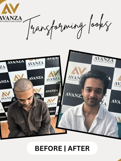 This client went from a shaved head with a defined balding pattern to a full head of thick, dark hair. The smile in the after photo shows his happiness with the result.