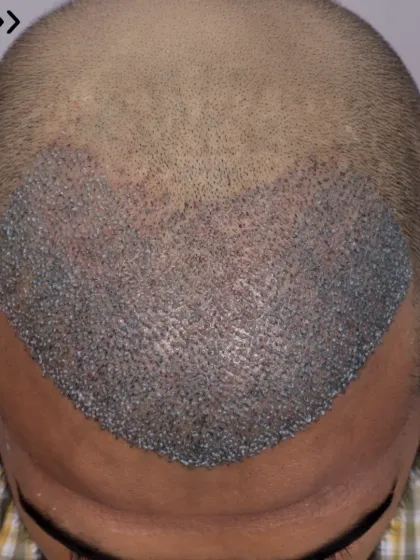 The beginning of a transformation for a Diffuse Grade 4a patient. 3400 grafts were placed to recreate the hairline and restore the frontal and mid-scalp.