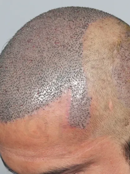 This patient came to us for a corrective hair transplant. We used 5500 grafts to recreate his hairline and re-densify the frontal part, mid-scalp, and crown.