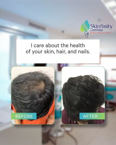 Hair Restoration & Removal