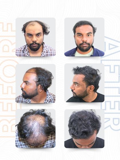 This is the story of Mr. Vishal, told in 4,576 grafts. Using the RT-FUE technique, I focused on strategic placement to achieve maximum density and a hairline that looks entirely natural. The results from all angles show a complete and satisfying transformation.