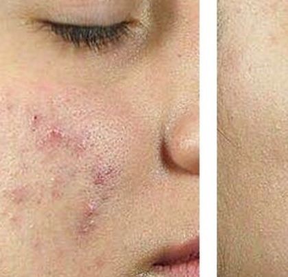 Here, you can see the successful reduction of redness and scarring. My treatments are designed not just to repair, but also to strengthen the skin barrier to prevent future inflammation.