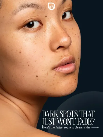 Are you dealing with dark spots that just won't fade? This image represents a common frustration for many, highlighting the need for professional intervention for stubborn pigmentation.